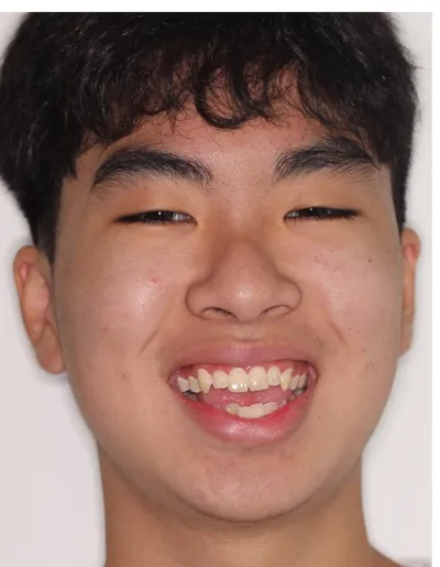 Before Metal Braces treatment - Case 87773