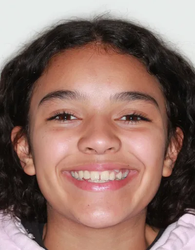 Before Metal Braces treatment - Case 87782