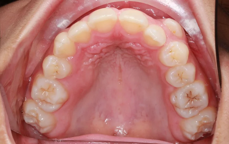 Upper Occlusal - Before Treatment