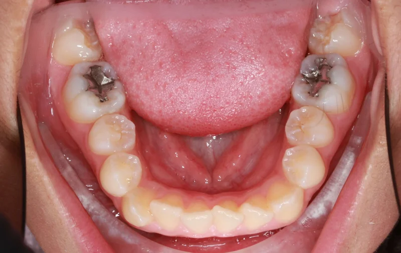 Lower Occlusal - Before Treatment