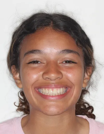 After Metal Braces treatment - Case 87782