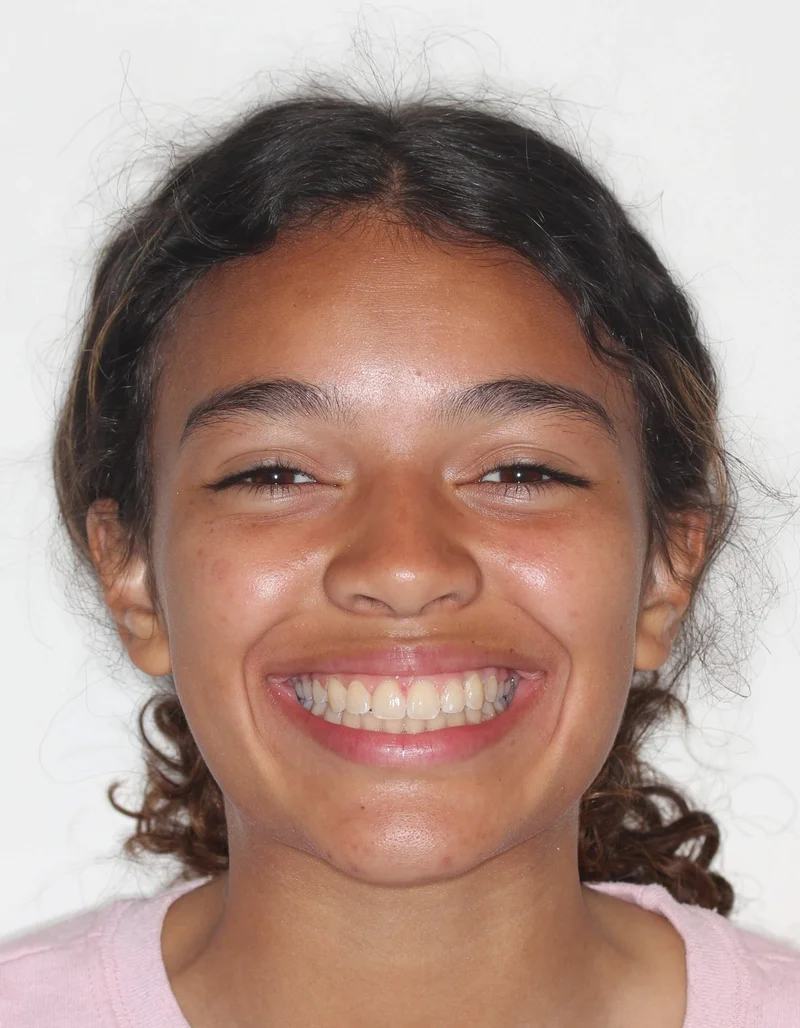 Facial Frontal Smiling - After Treatment