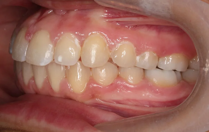 Left Buccal - After Treatment