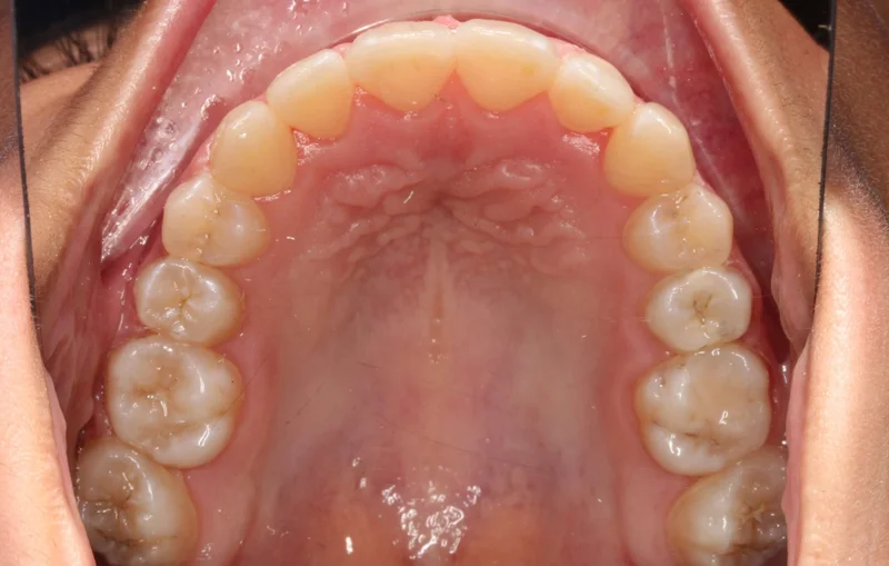 Upper Occlusal - After Treatment