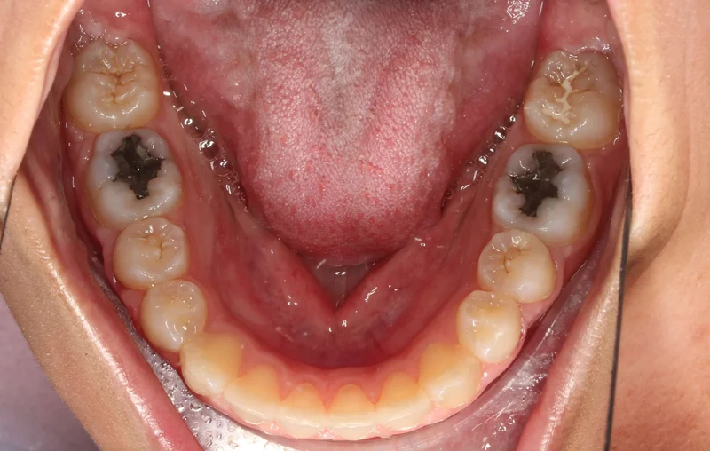 Lower Occlusal - After Treatment