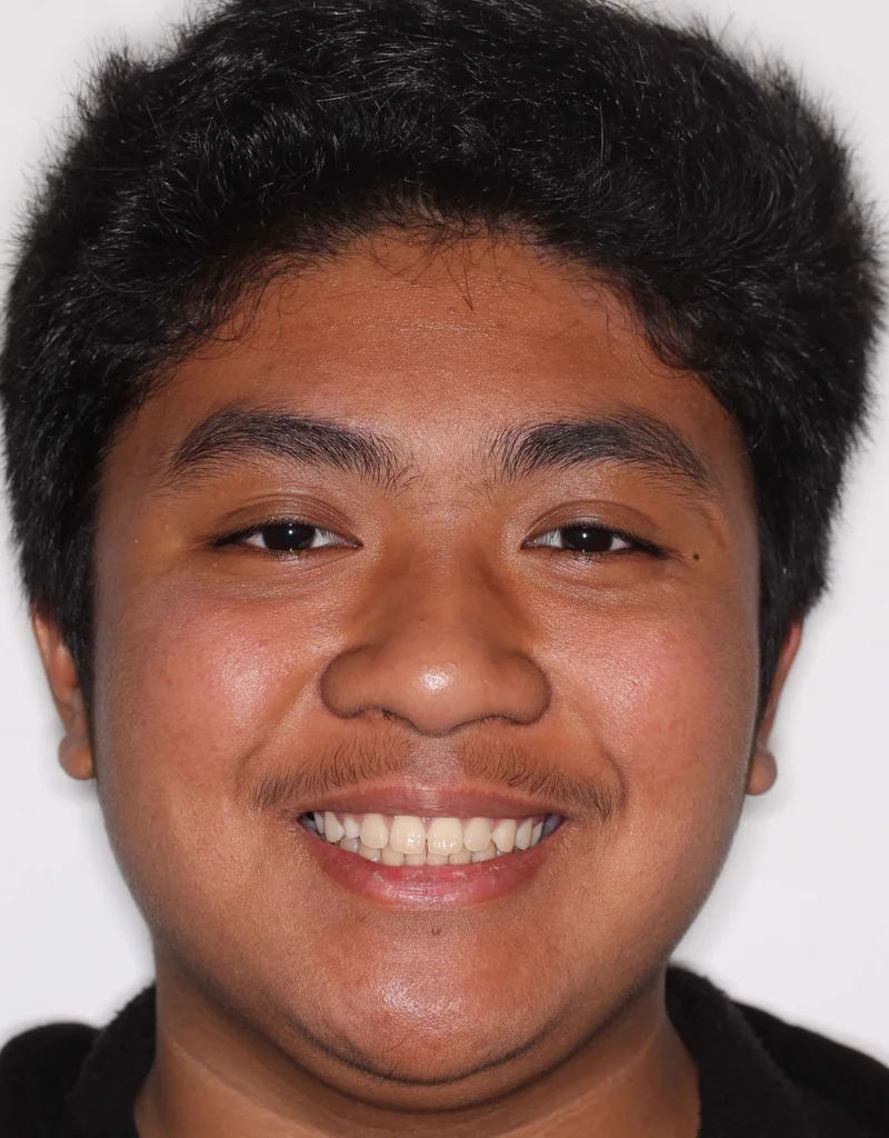 Facial Frontal Smiling - Before Treatment