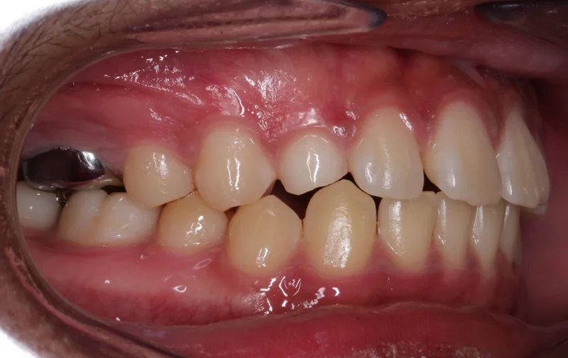 Right Buccal - Before Treatment