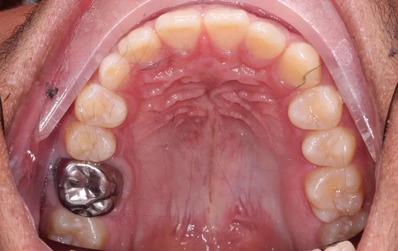 Upper Occlusal - Before Treatment