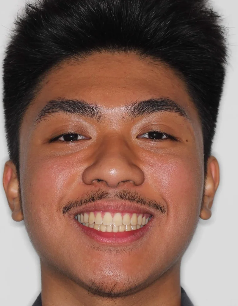 Facial Frontal Smiling - After Treatment