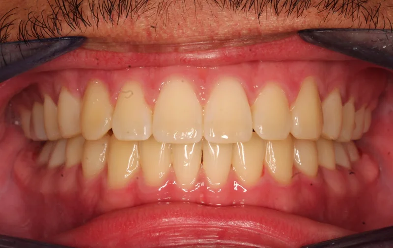 Center - After Treatment