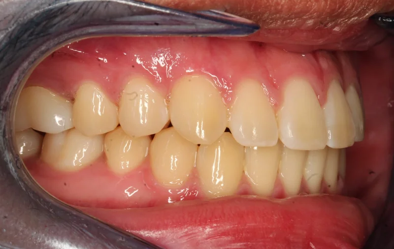 Right Buccal - After Treatment