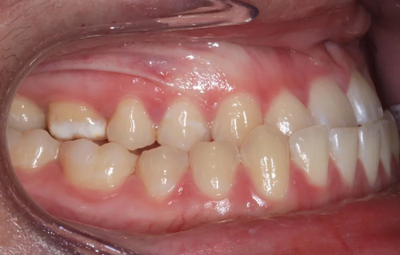 Right Buccal - Before Treatment