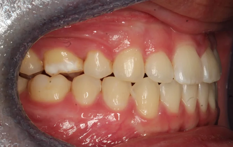Right Buccal - After Treatment