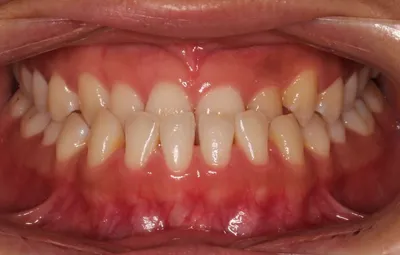Before Clear Aligners treatment - Case 91885