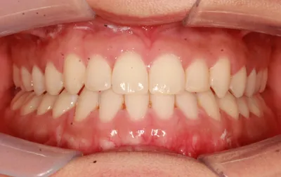 After Clear Aligners treatment - Case 91885