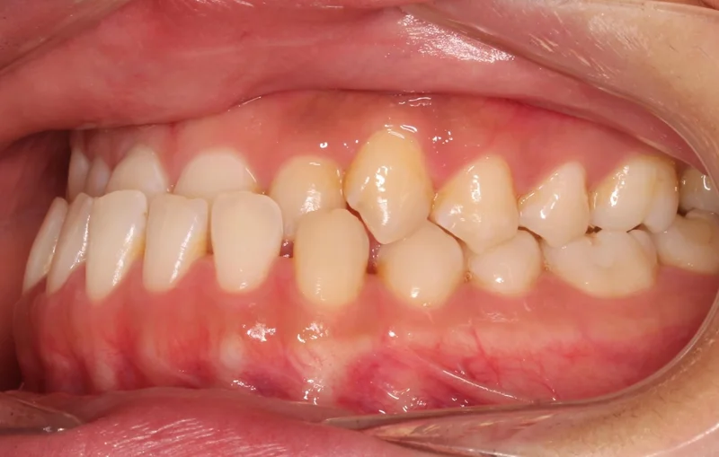 Left Buccal - Before Treatment