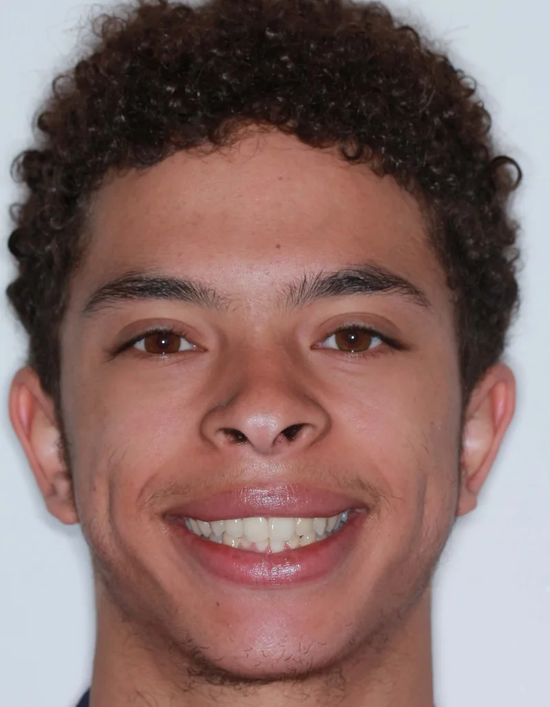 Facial Frontal Smiling - Before Treatment