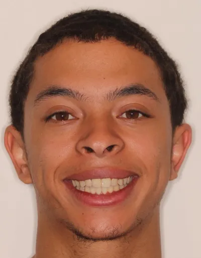 After Metal Braces treatment - Case 91890