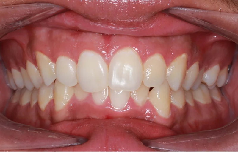 Center - Before Treatment