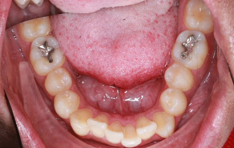 Lower Occlusal - Before Treatment