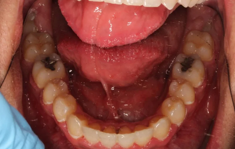 Lower Occlusal - After Treatment