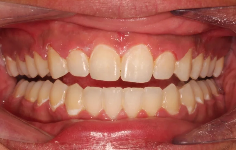 Center Open Smile - After Treatment