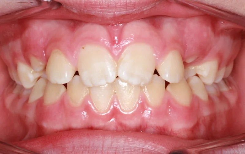 Center Smile - Before Treatment