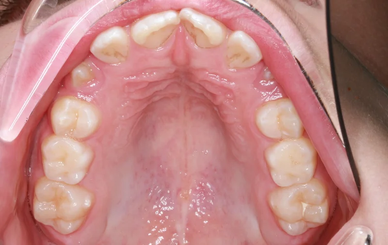 Upper Occlusal - Before Treatment
