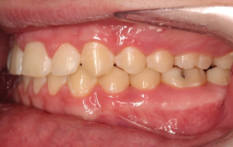 Left Buccal - After Treatment