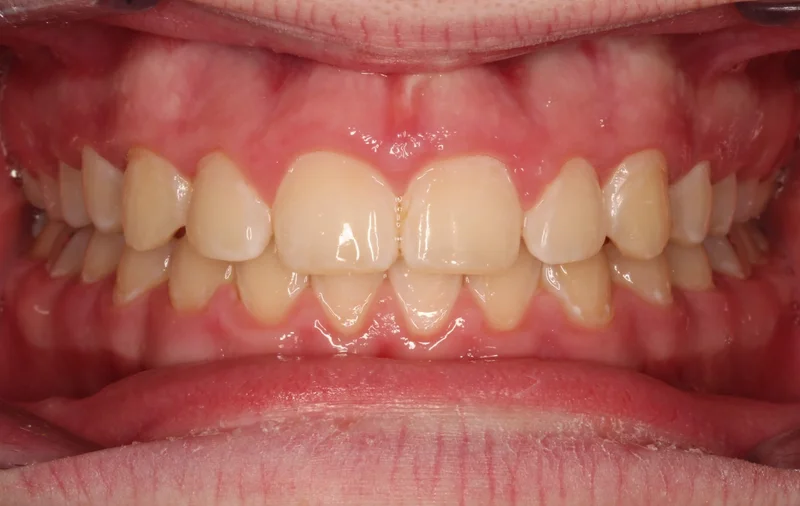 Center Smile - After Treatment