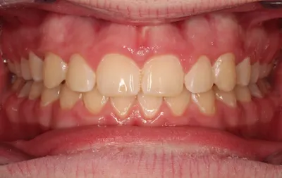 After Metal Braces treatment - Case 91892