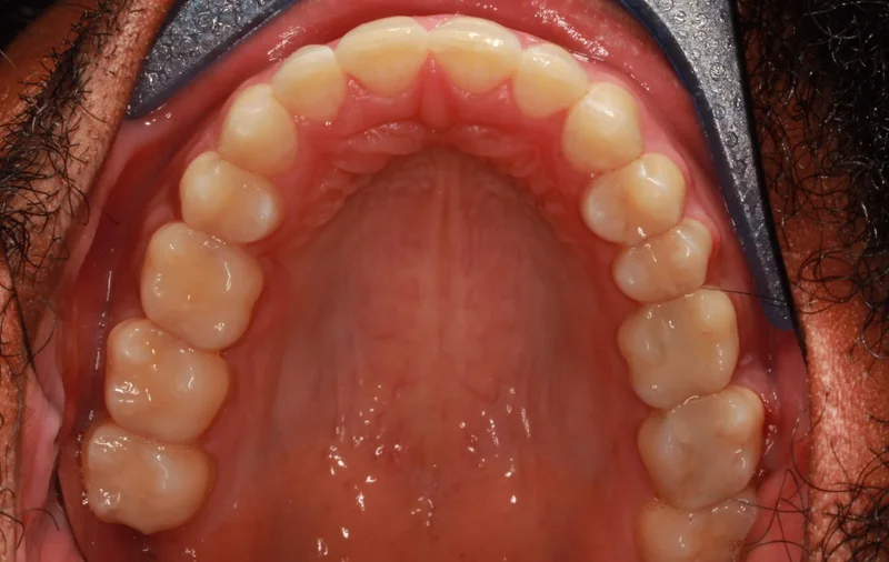 Upper Occlusal - After Treatment