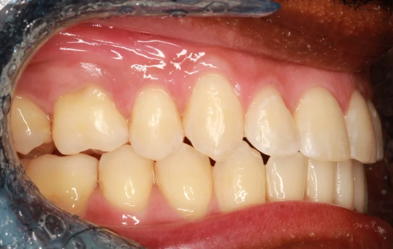 Right Buccal - After Treatment