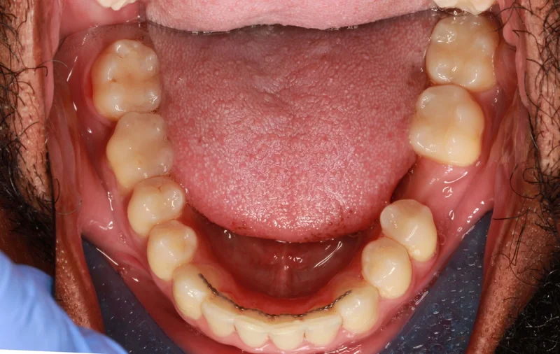 Lower Occlusal - After Treatment