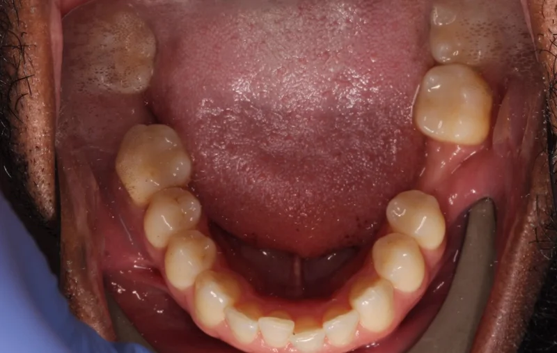 Lower Occlusal - Before Treatment