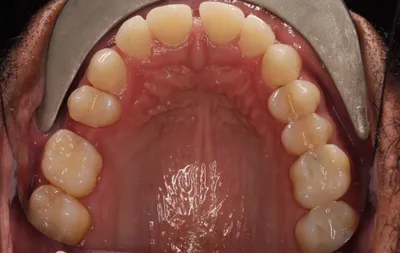 Before Metal Braces treatment - Case 91937