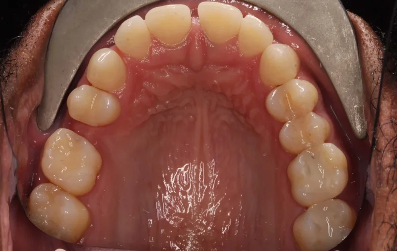 Upper Occlusal - Before Treatment