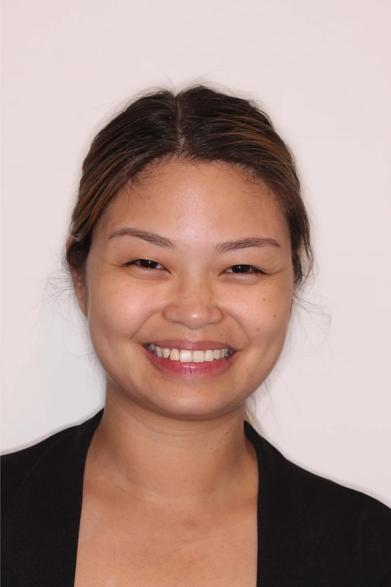 Front Facial Smiling - Before Treatment