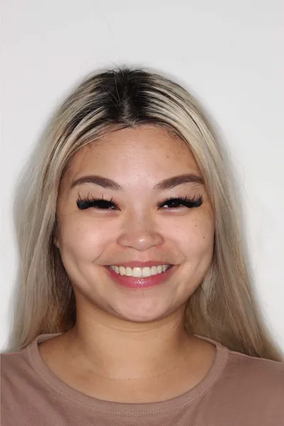 After Metal Braces treatment - Case 92665