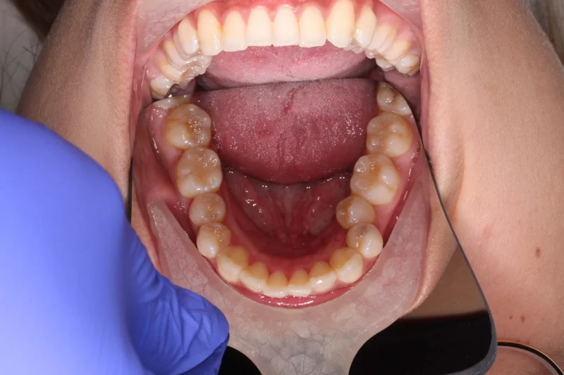 Lower Occlusal - Before Treatment