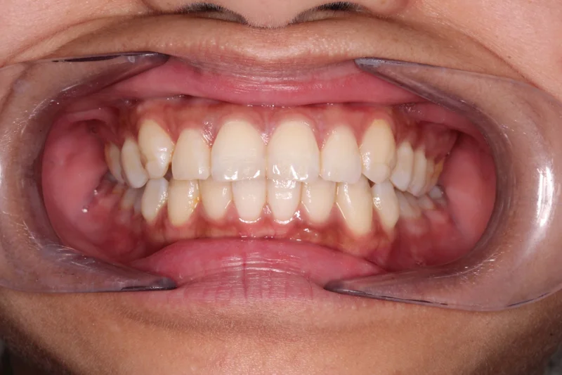 Center - Before Treatment