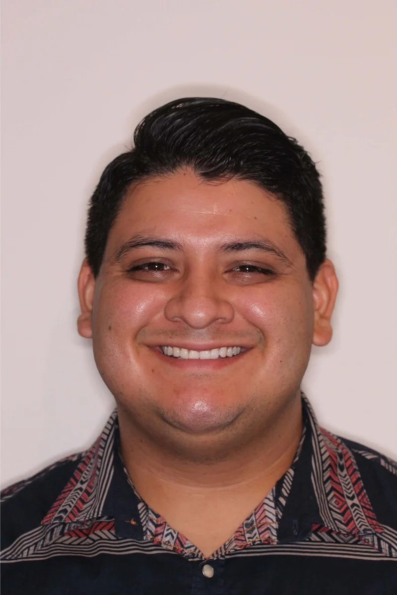 Front Facial Smiling - Before Treatment