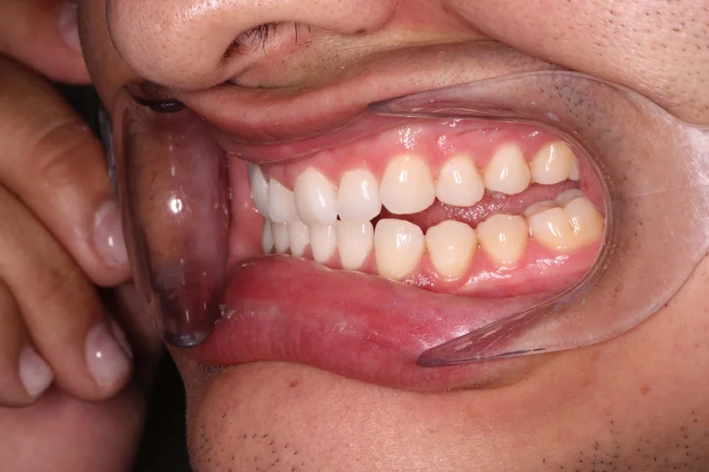 Left Buccal - Before Treatment