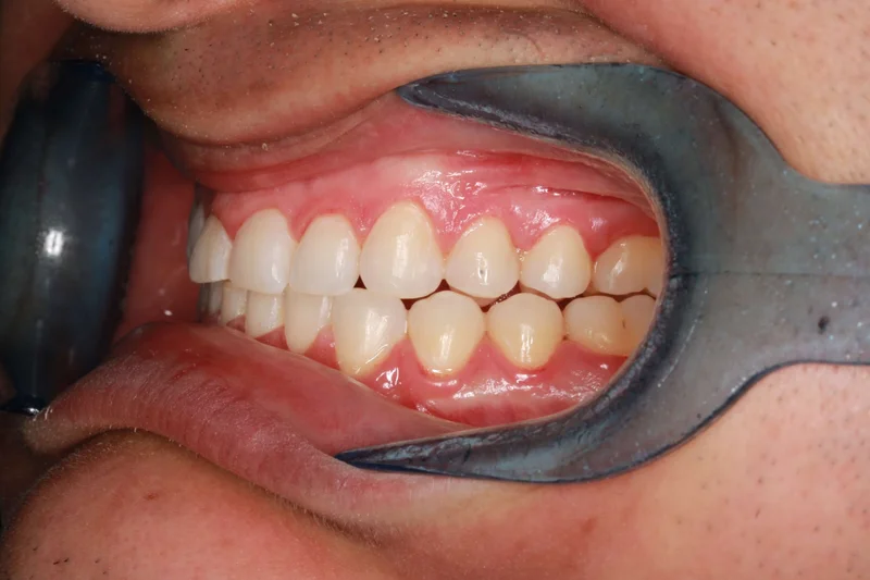 Left Buccal - After Treatment