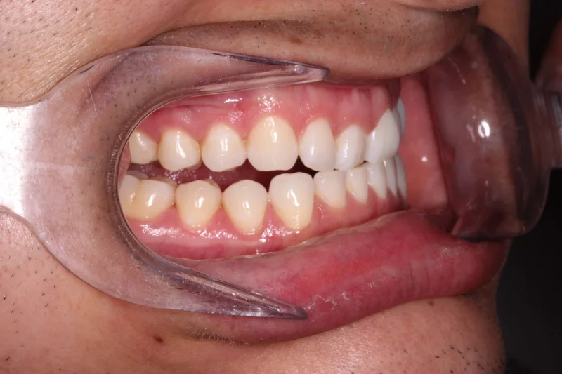 Right Buccal - Before Treatment