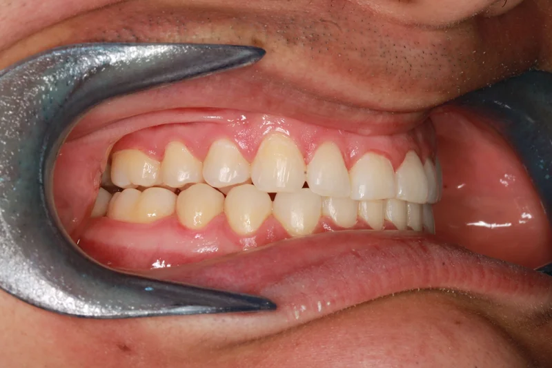 Right Buccal - After Treatment