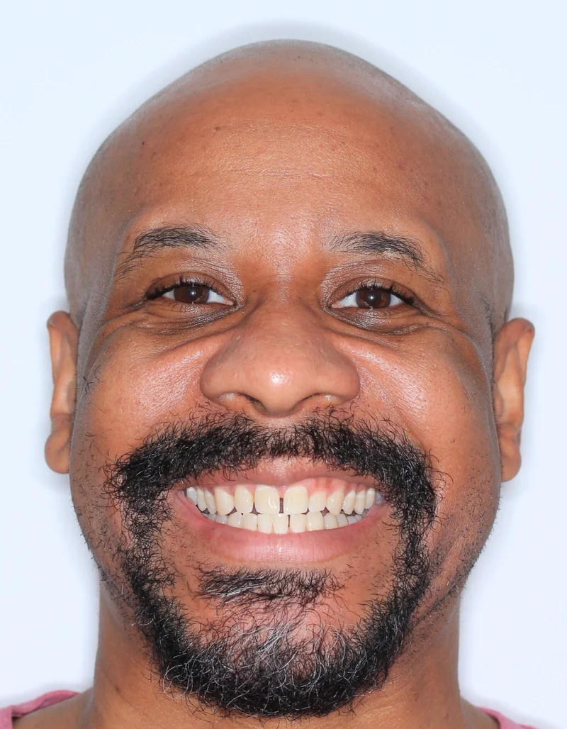 Front Facial Smiling - Before Treatment