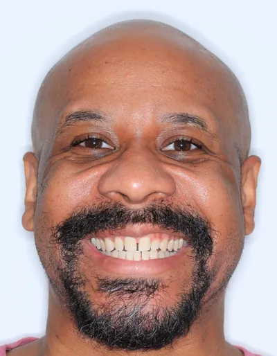 Before Metal Braces treatment - Case 92723