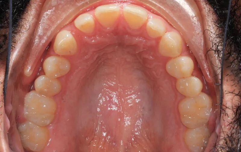 Upper - Before Treatment