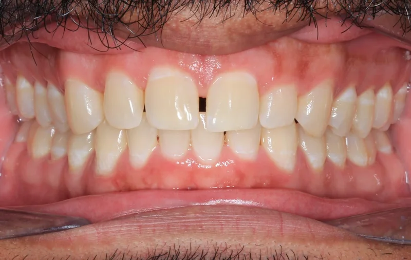 Center - Before Treatment